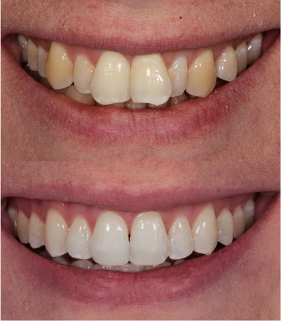 before and after dental crown teeth