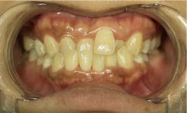man smiling with crossbite