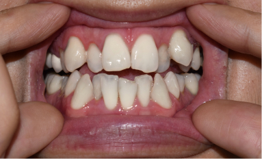 image of crowded teeth, overlapping each other