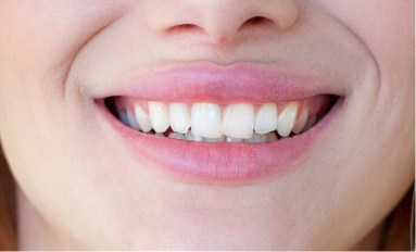 lady smiling with deep bite