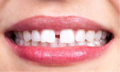 lady smiling with gapped teeth