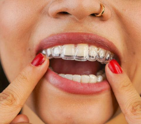 women inserting invisalign