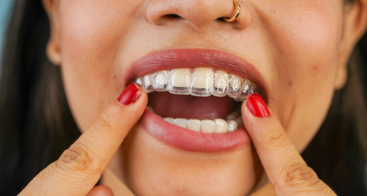 women inserting invisalign