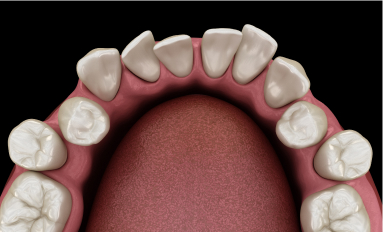 diagram of misaligned teeth
