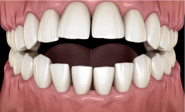 example of open bite