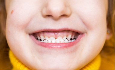 kid smiling with underbite