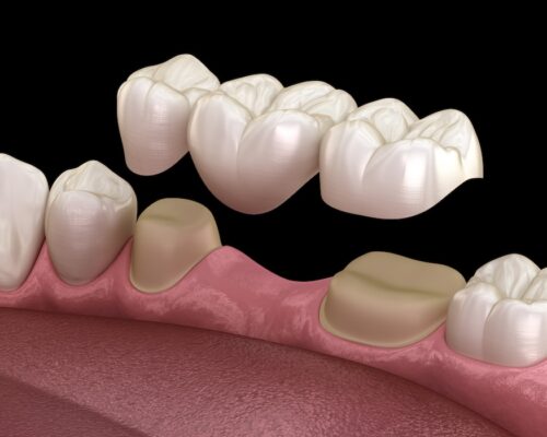 Dental bridge of 3 teeth over molar and premolar. Medically accurate 3D illustration of human teeth treatment