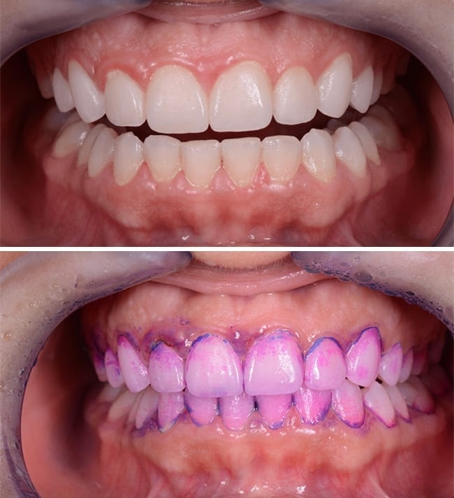 tooth covered in pink stain remover