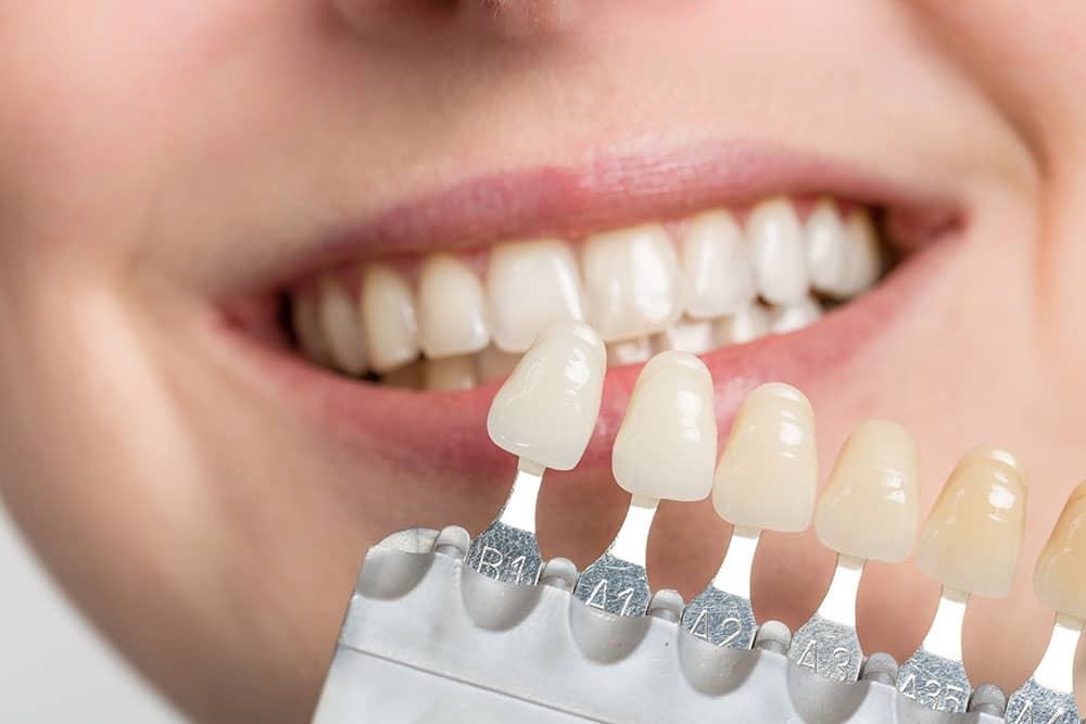 coloured veneers porcelain